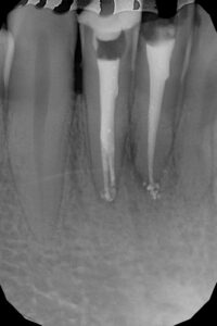 endodonzia