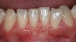 12 Situazione clinica dei tessuti molli a 6 mesi Parodontologia