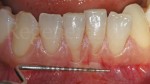 4 Assenza di tessuto cheratinizzato su 4.1 Parodontologia