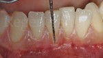 2 Recessione di 3 mm su 4.1, 2 mm su 3.1 Parodontologia