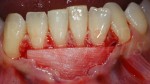 8 Posizionamento della matrice collagenica Geistlich Mucograft Parodontologia