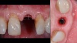 11 Risultato del ondizionamento mucoso dopo 3 mesi parodontologia