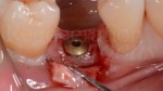 7 Innesto di Geistilch Bio-Oss parodontologia