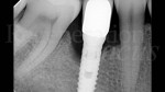 1 RX pre-operatoria parodontologia