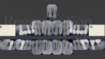 1 Full RX dopo terapia causale parodontologia