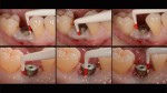 2 Sondaggi pre-operatori parodontologia