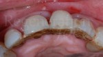 3 Splint del suo incisivo, difetto orizzontale parodontologia