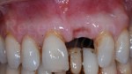 4 Difetto verticale parodontologia