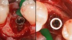 4 Difetto degranulato parodontologia