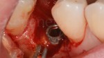 6 Applicazione di tetraciclina parodontologia