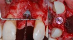 6 Impianto a 3 mm dalla CEJ del 22 parodontologia