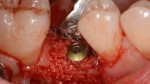 7 Innesto di Geistilch Bio-Oss parodontologia
