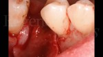 8 Collocazione di una membrana Geistlich Bio-Gide parodontologia