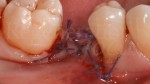 9 Sutura Vycril parodontologia